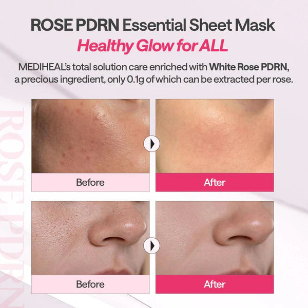 MEDIHEAL Rose PDRN Essential Mask 24ml 1 Box 10 pieces Results